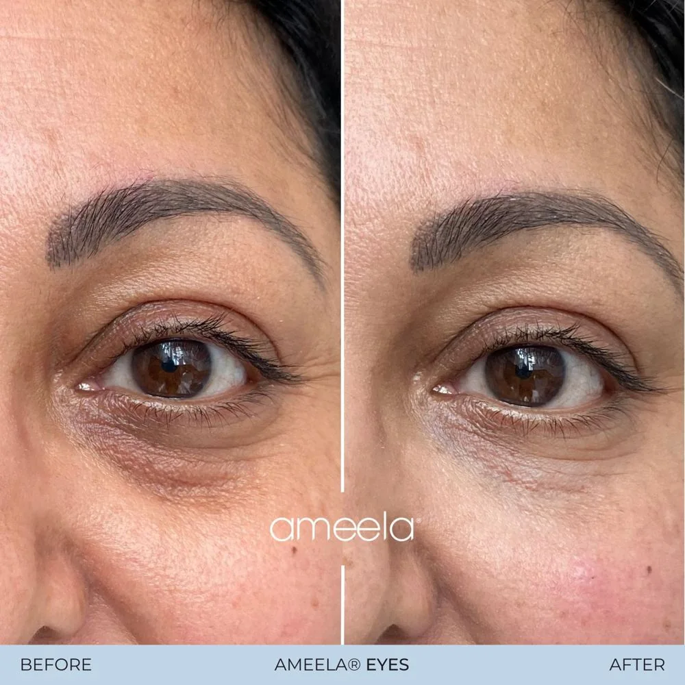 Under-eye rejuvenation: before and after