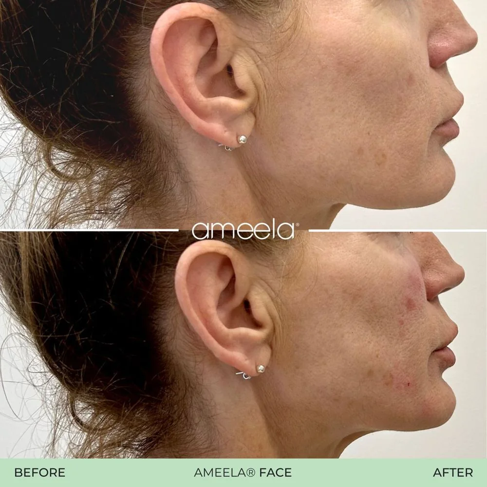 Skin rejuvenation: before and after