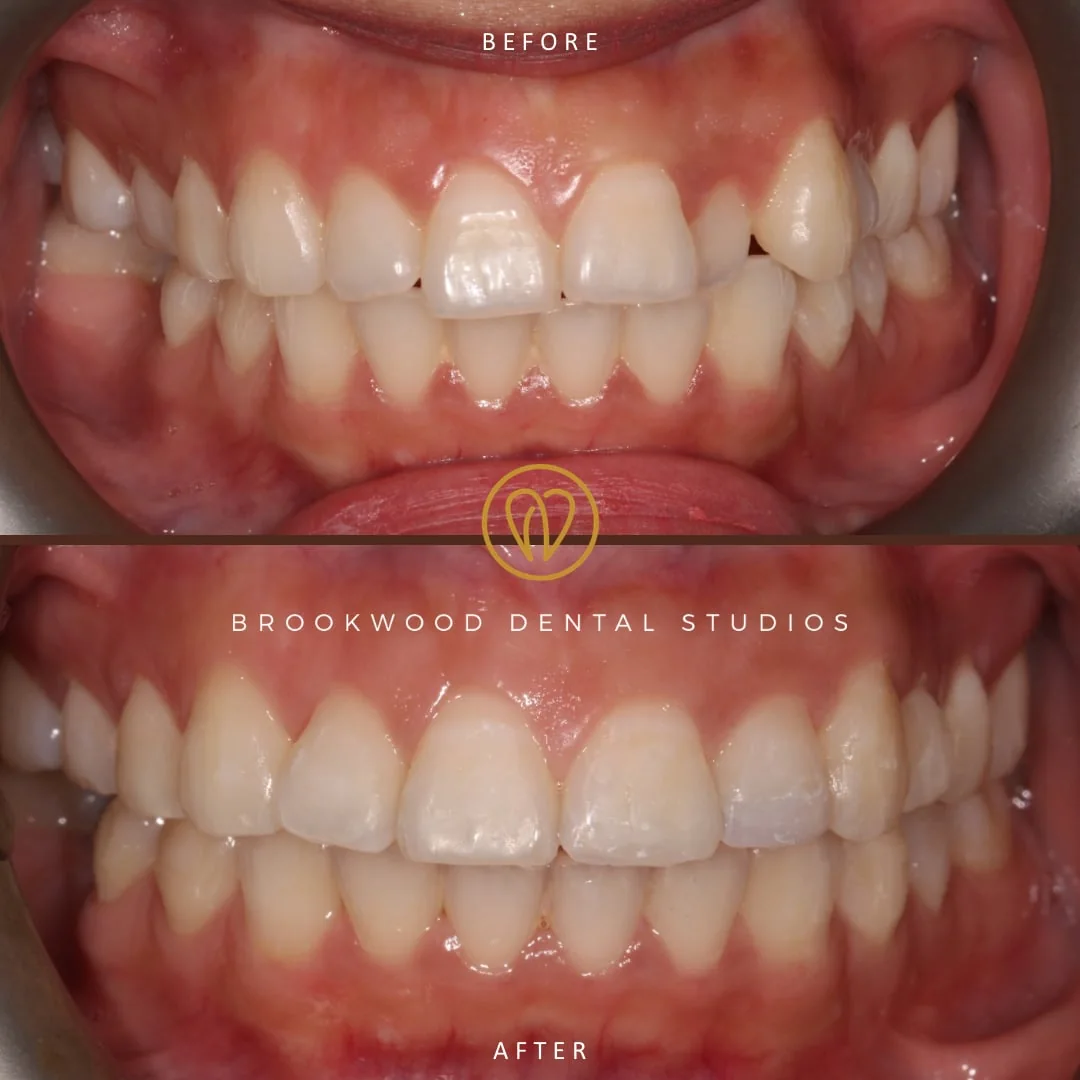 Orthodontics & braces: before and after, a patient treated at Brookwood Dental Studios