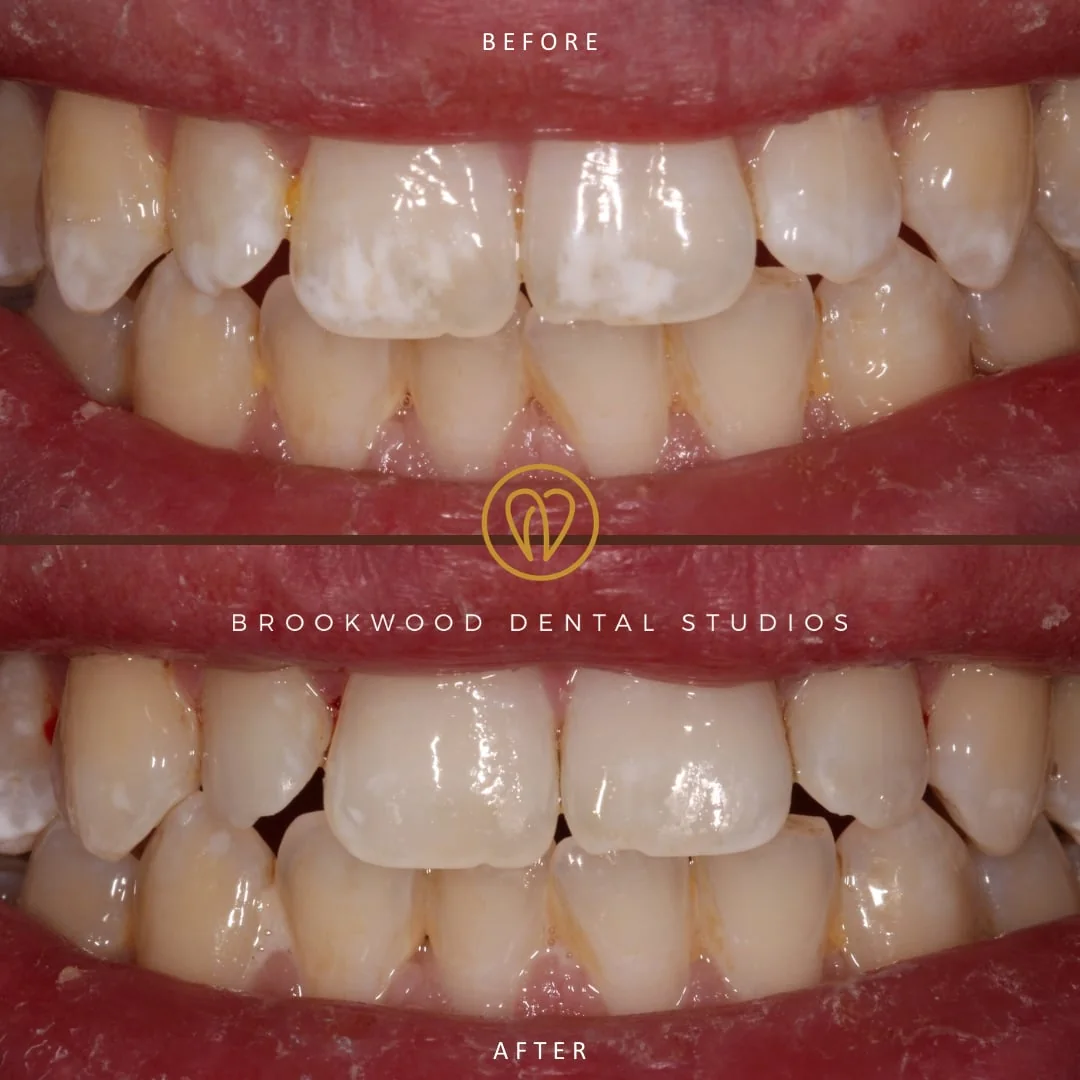 White spot removal: before and after, a patient treated at Brookwood Dental Studios